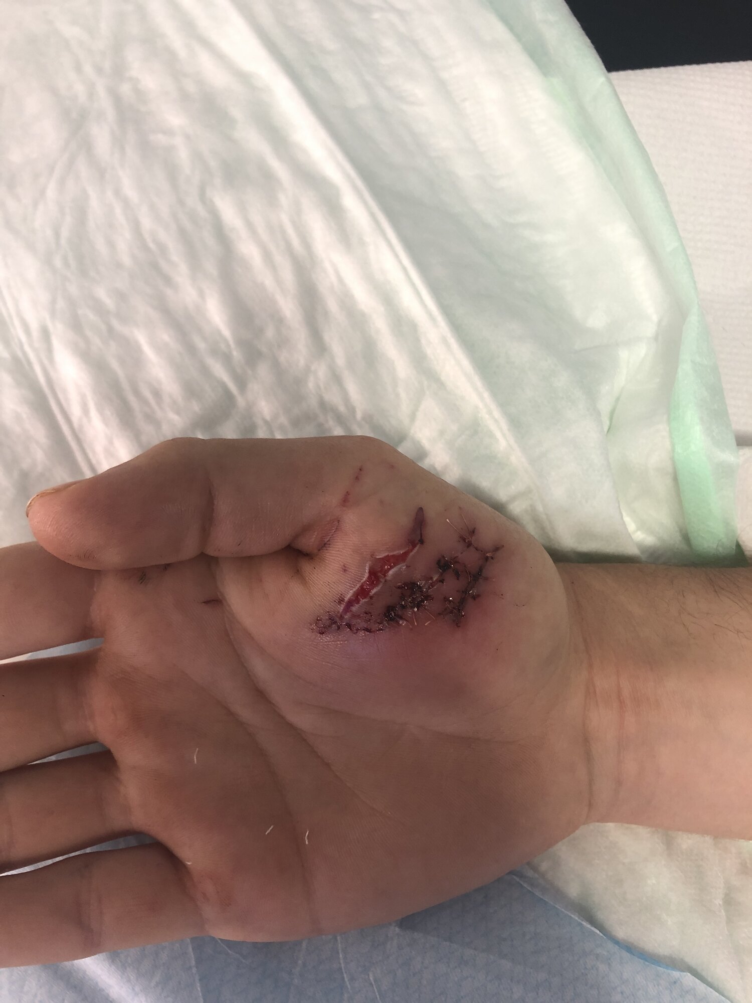 Accident-Related Wounds