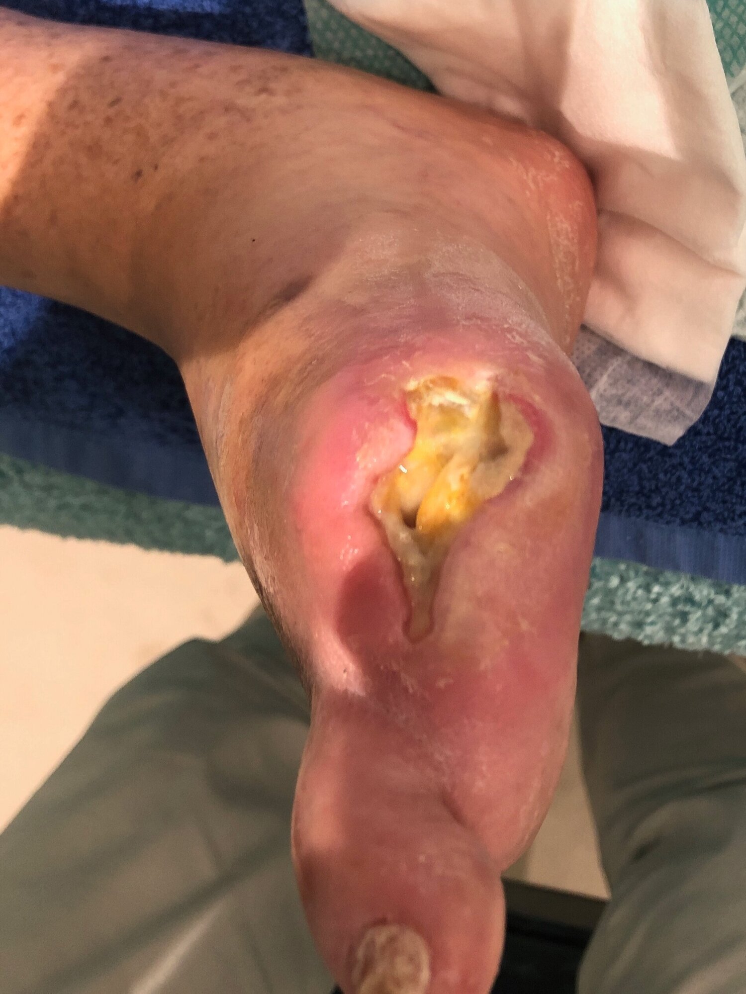 Diabetic Foot Ulcers